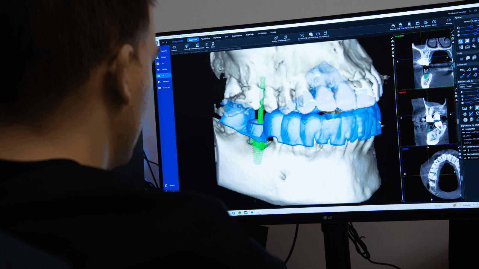 Implantes Dentales Guiados Por Ordenador