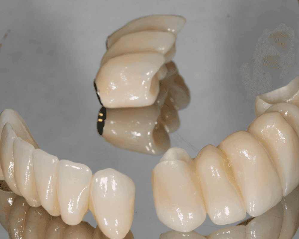 Coronas Zirconio