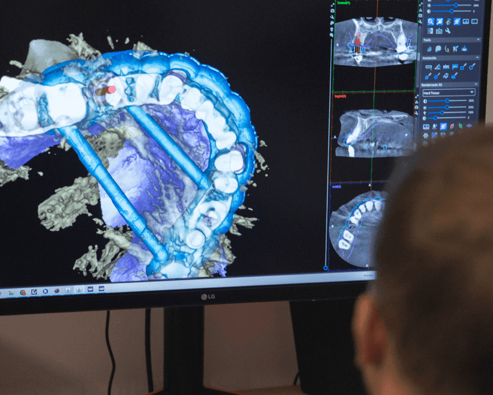 Implantes Carga Inmediata