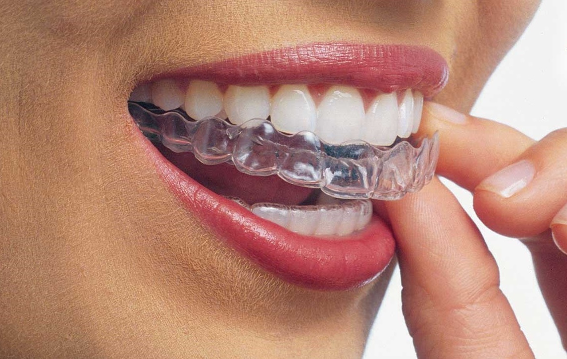 Ortodoncia invisible – Ortodoncia transparente – Invisalign